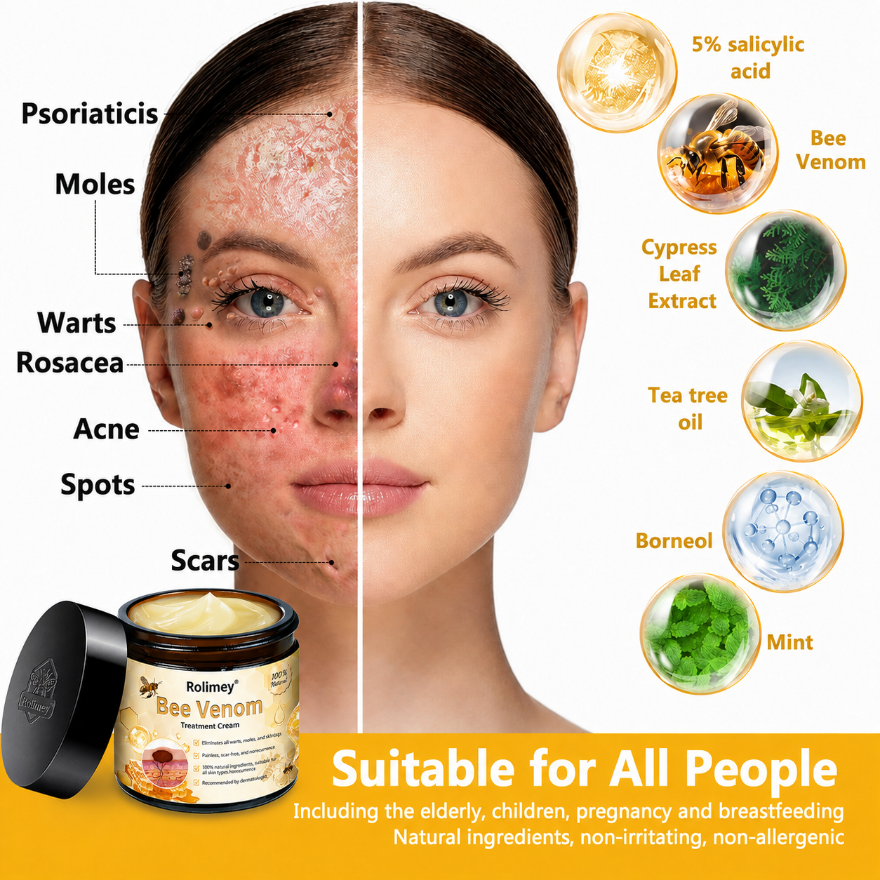 🌿Rolimey® Bee Venom Skin Treatment Cream - (Helping with acne, wart, rosacea, psoriasis, age spots, eczema, and reducing the appearance of stretch marks)