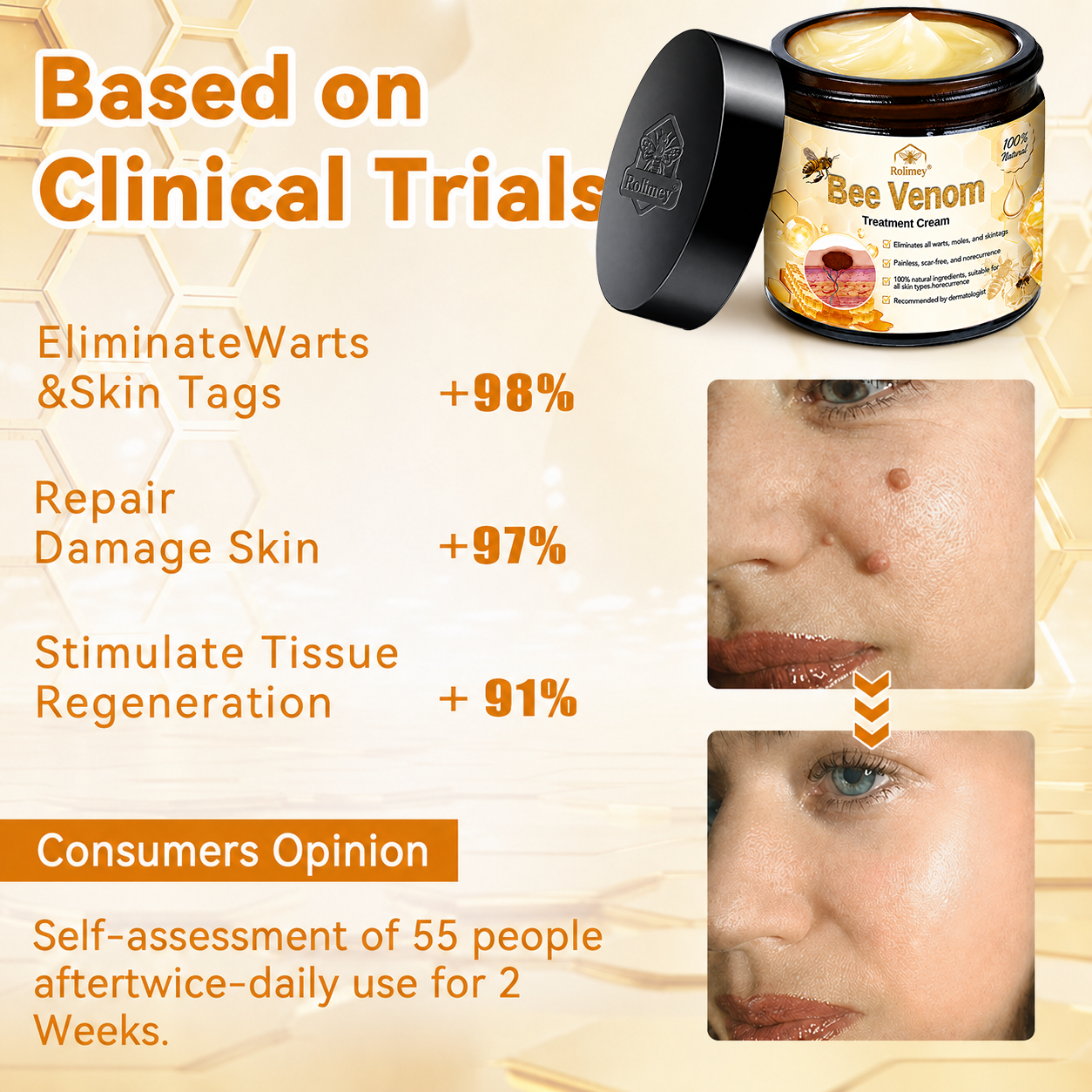 🌿Rolimey® Bee Venom Skin Treatment Cream - (Helping with acne, wart, rosacea, psoriasis, age spots, eczema, and reducing the appearance of stretch marks)