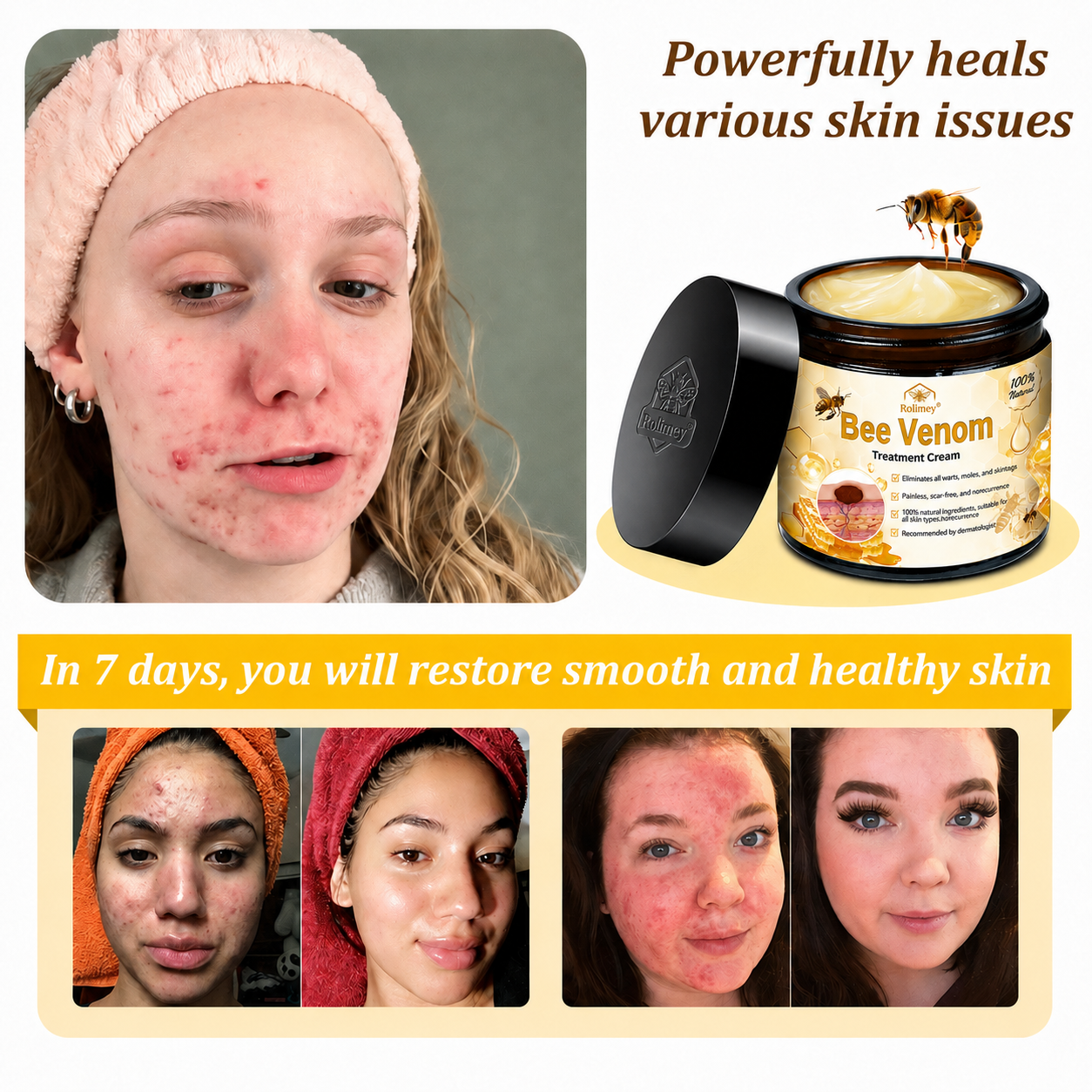 🔥Rolimey® Bee Venom Skin Treatment Cream