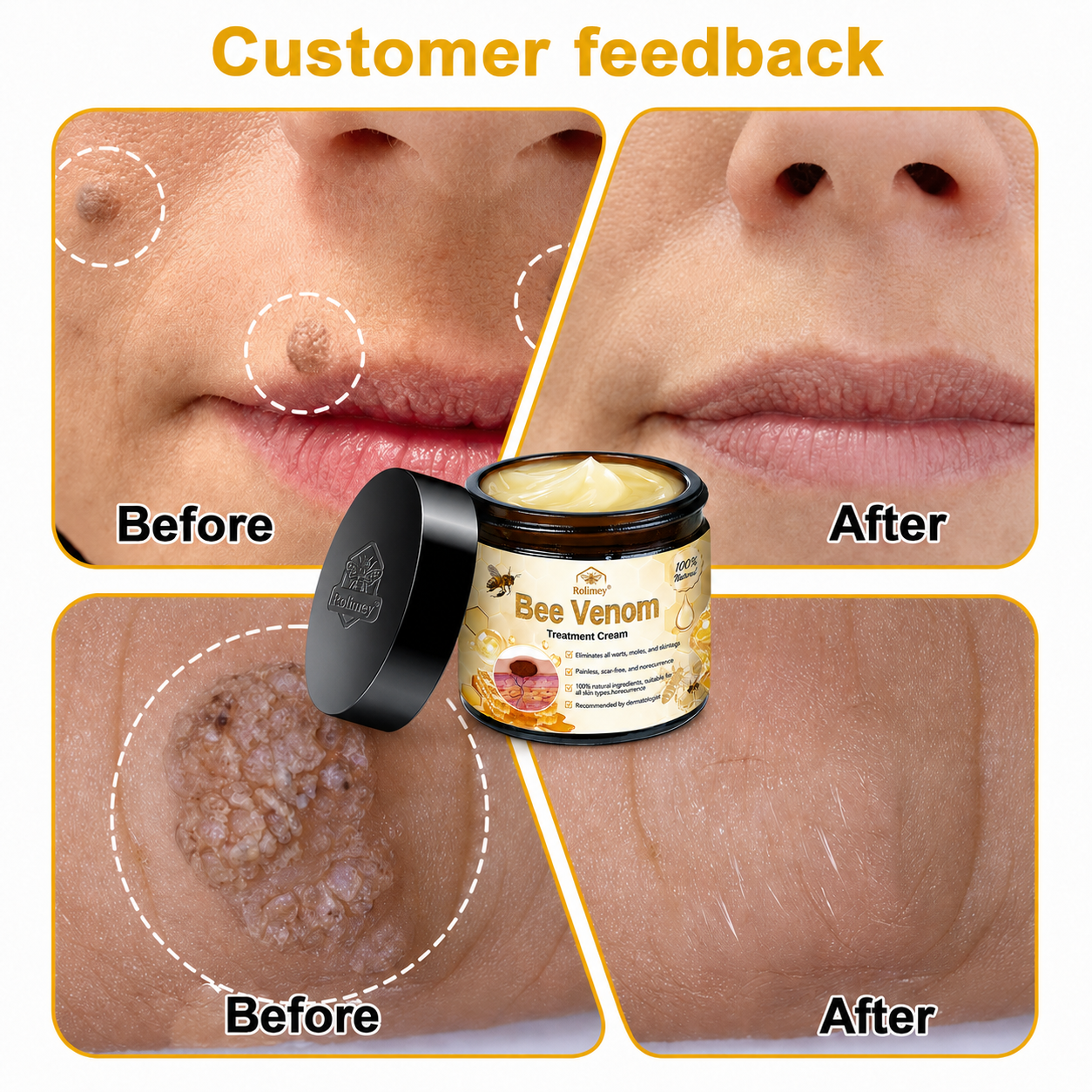 🌿Rolimey® Bee Venom Skin Treatment Cream - (Helping with acne, wart, rosacea, psoriasis, age spots, eczema, and reducing the appearance of stretch marks)